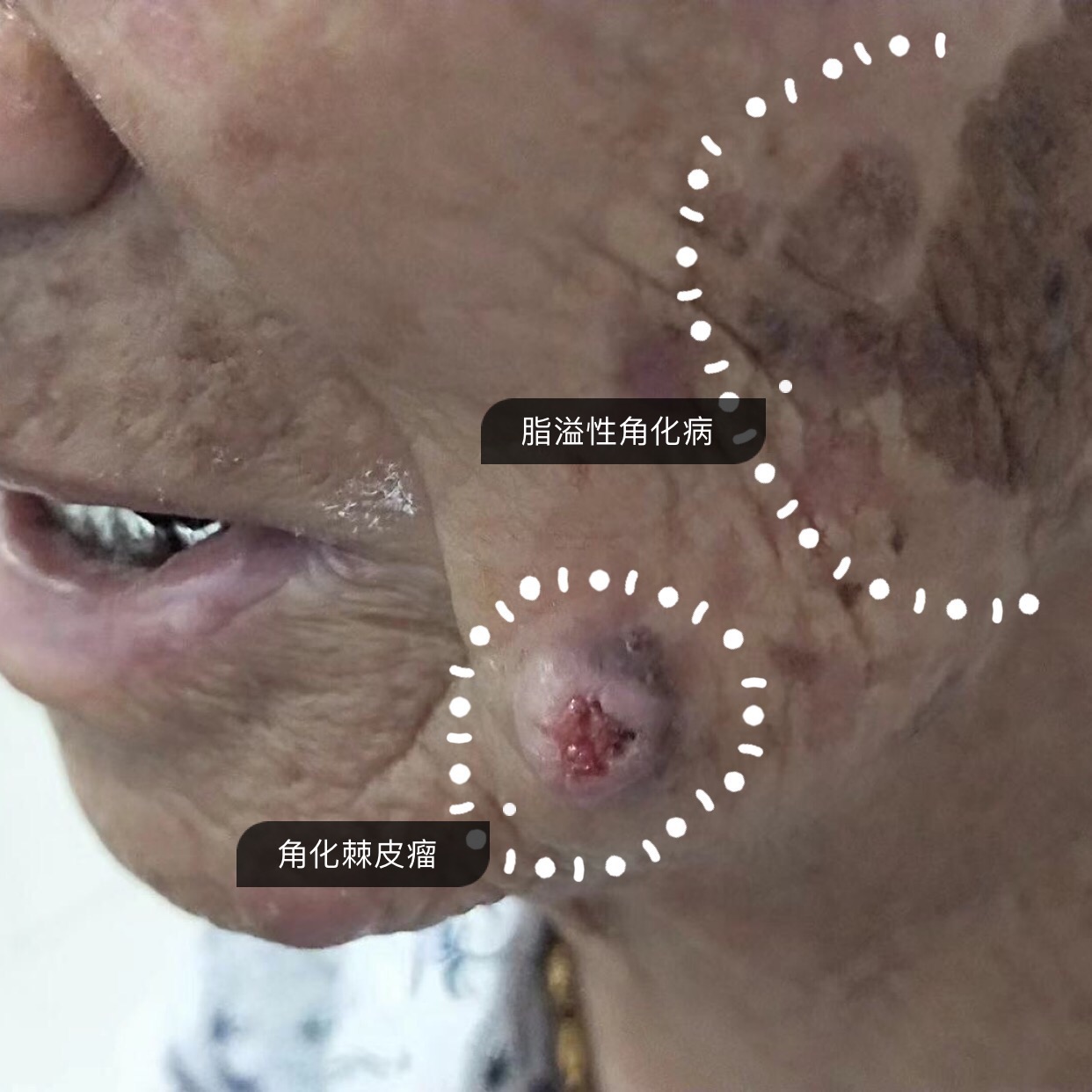 85岁娭毑的皮肤问题——都是不防晒的错