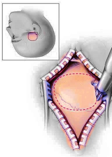 长了听神经瘤可以做微创手术吗？手术风险大吗？