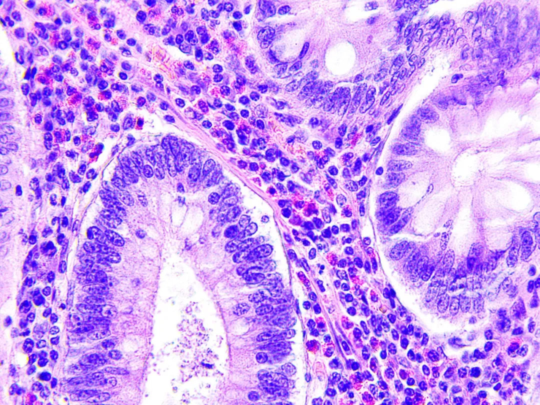 快讯|科学家利用胎盘干细胞来治疗早产儿结肠炎等多种疾病