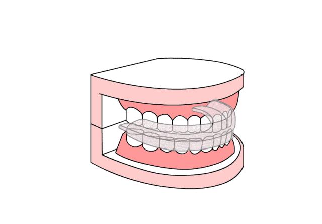 老年塞牙如何正确解决,老年人牙缝大塞牙最好的解决方案