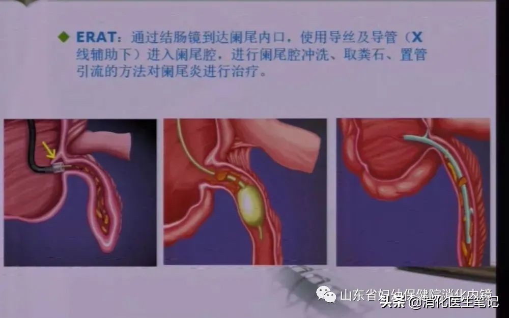 阑尾炎不开刀还有其他办法,治疗阑尾炎的最好的治愈方法