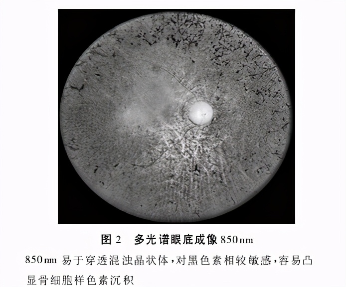 视网膜色素变性是一种常见眼病吗,视网膜色素变性是什么病