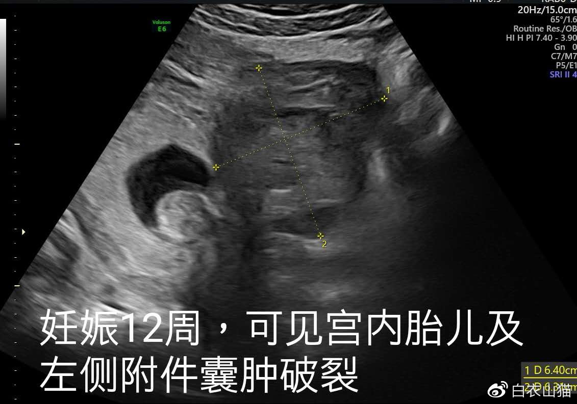 双胞胎一个宫内一个宫外大出血,双胞胎一个流产一个宫外孕