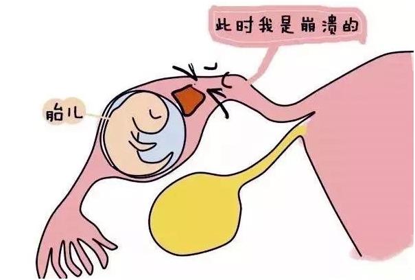 有盆腔炎的女性一般都会宫外孕吗,为什么盆腔炎会宫外孕