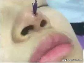 线雕鼻做了好看吗,鼻子短做线雕隆鼻好看吗