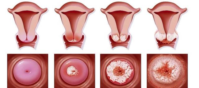 念珠菌性阴道炎的症状及处理方法,什么叫做念珠菌性外阴炎