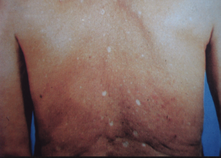 白斑是白癜风吗医生为你详解,得了白癜风感觉身上都是白斑