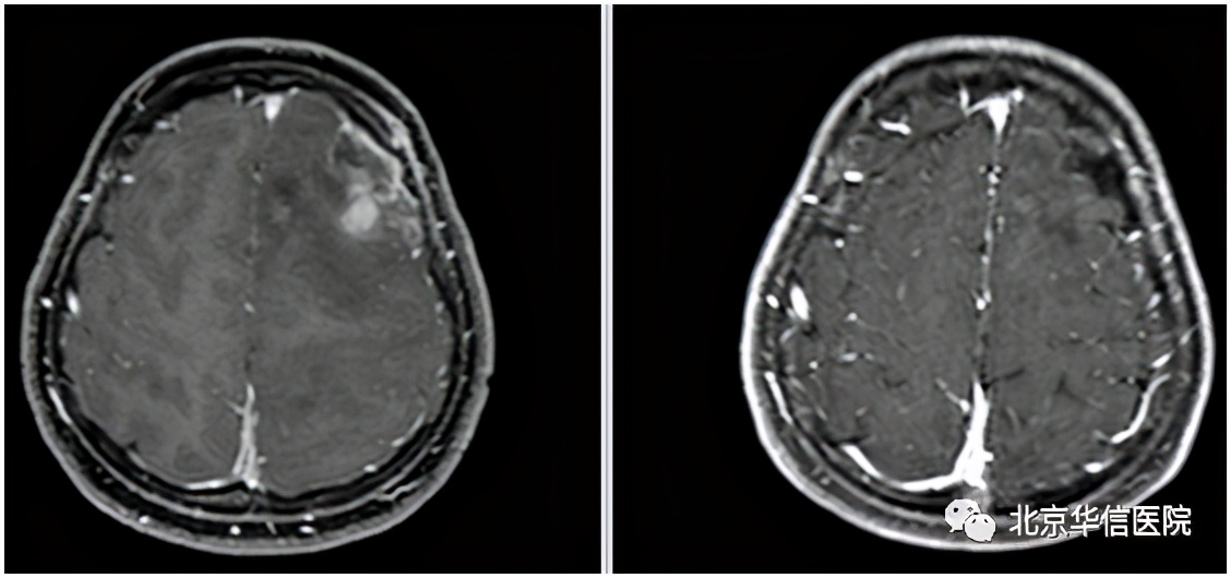 清华大学第一附属医院治疗癌症,清华一附院放疗