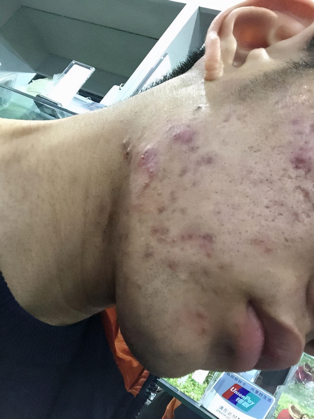 战痘的正确方法图解,五个“战痘”小妙招