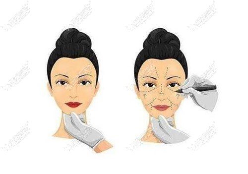 拉皮耳后形成疤痕怎么回事,拉皮手术耳后增生会慢慢变淡吗