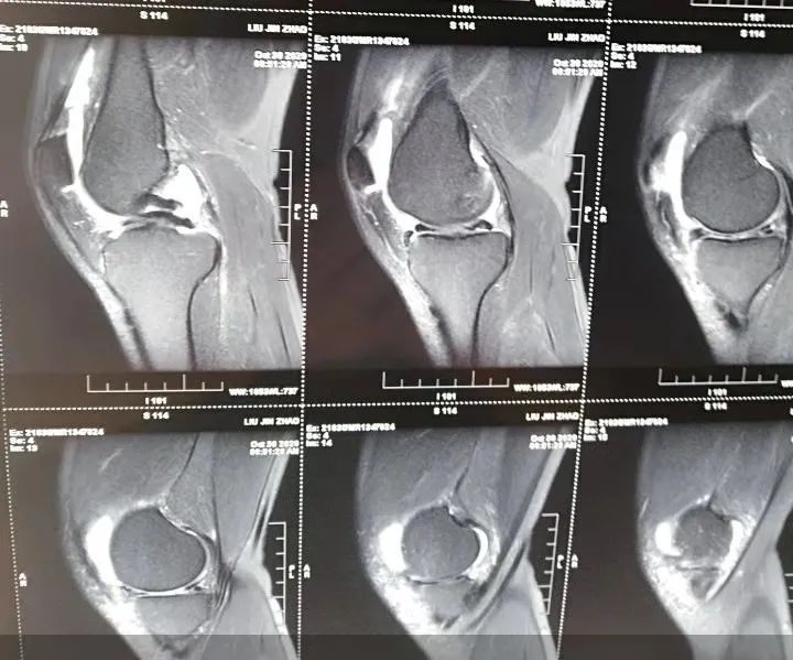 半月板损伤到底是怎么一回事,半月板后角损伤二级算严重吗
