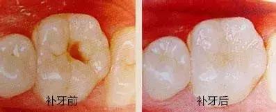 当牙齿出现小白点应该怎么办,当牙齿有黑线条