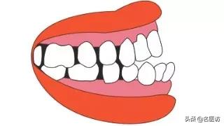 矫正牙齿医生叫打骨钉可以不打吗,正畸打骨钉当天就要挂橡皮筋了吗