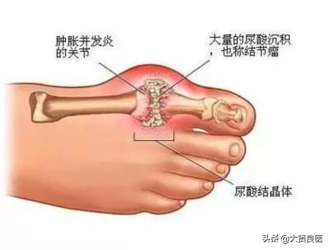 痛风,为什么我坚持中医治疗?