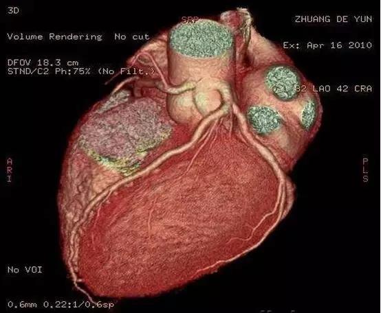 怀疑有冠心病必须做冠脉ct造影吗,确诊冠心病有必要做冠脉CTA吗