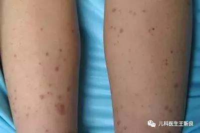 紫癜讲解,紫癜的介绍