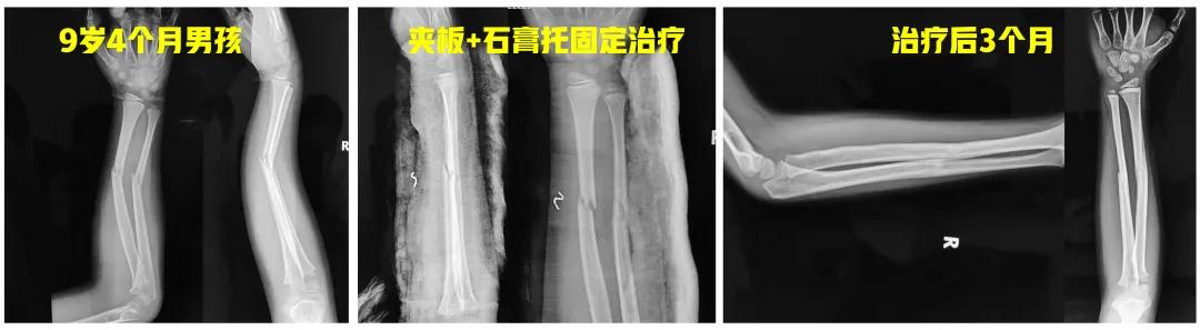 两个儿童前臂骨折争议病例之——元芳你怎么看