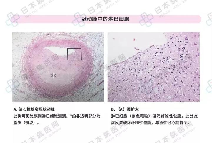所有的炎症都是细菌感染吗,所有的疾病都是由病原体引起的吗