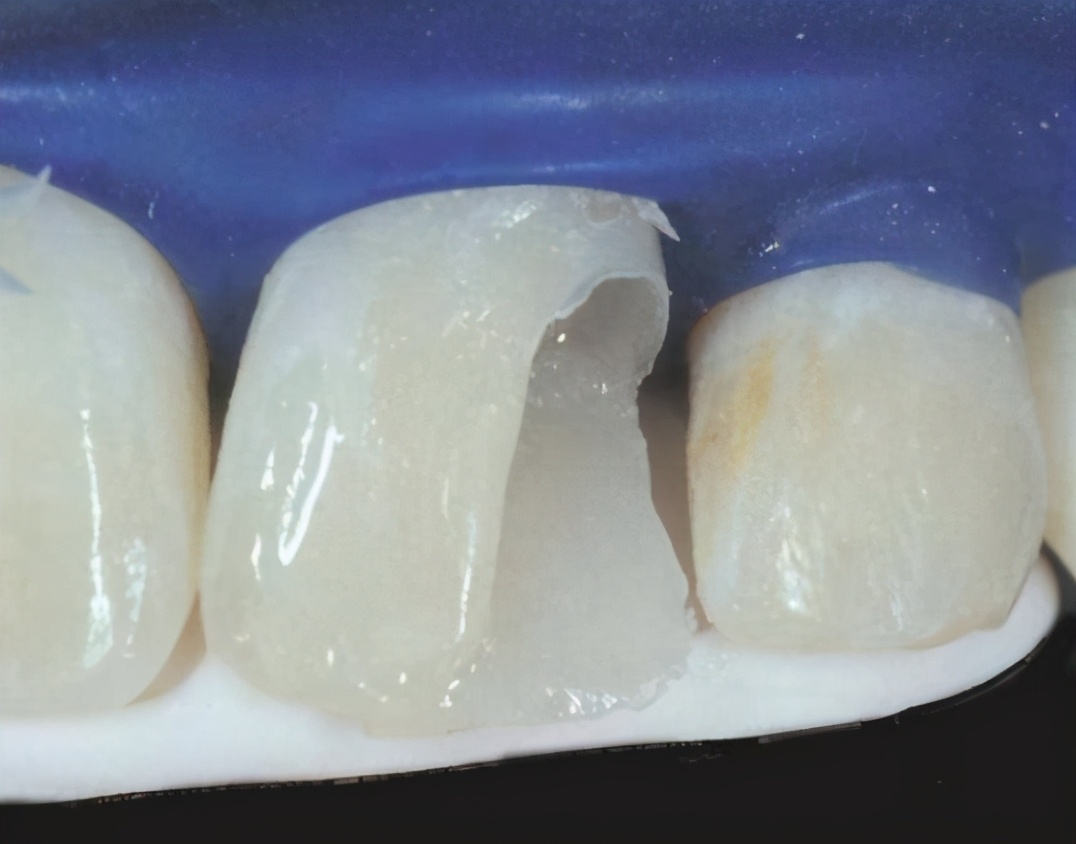 烤瓷牙寿命到了有哪些特征,烤瓷牙的寿命一般是多久