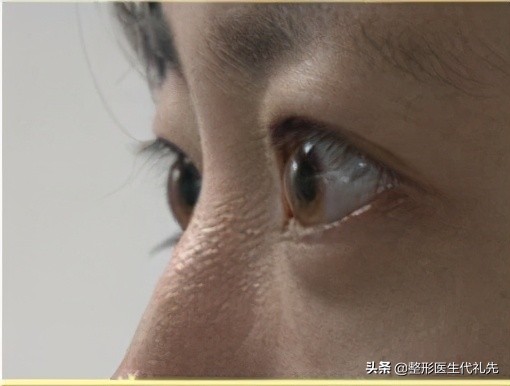 近视凸眼能做双眼皮吗,眼睛凸可以做手术改变吗