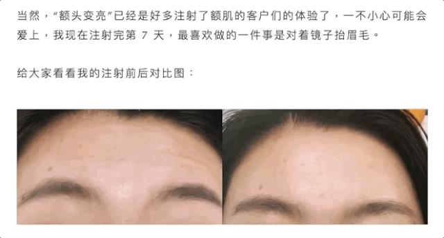 瘦脸针和提升脸部紧致打什么针,皮肤科医生祛脸皱纹