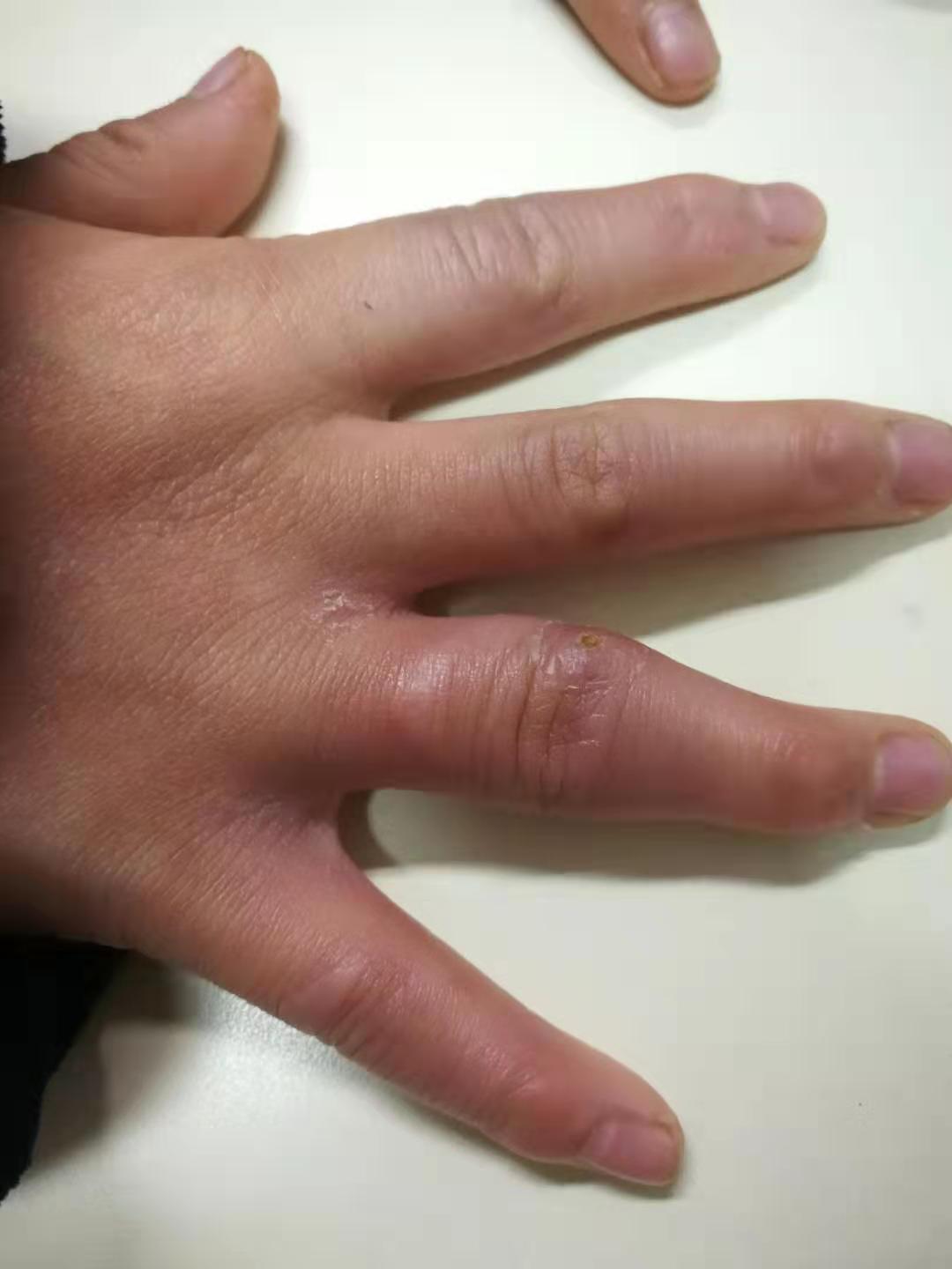 孩子长期腿关节疼,小孩子说腿痛关节痛