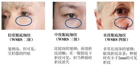 眼周的细纹已经彻底暴露了年龄,眼周的细纹越来越明显怎么办