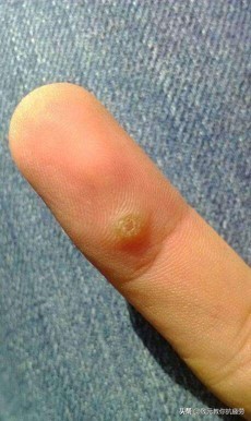 长疣怎么预防,丝线疣怎么预防