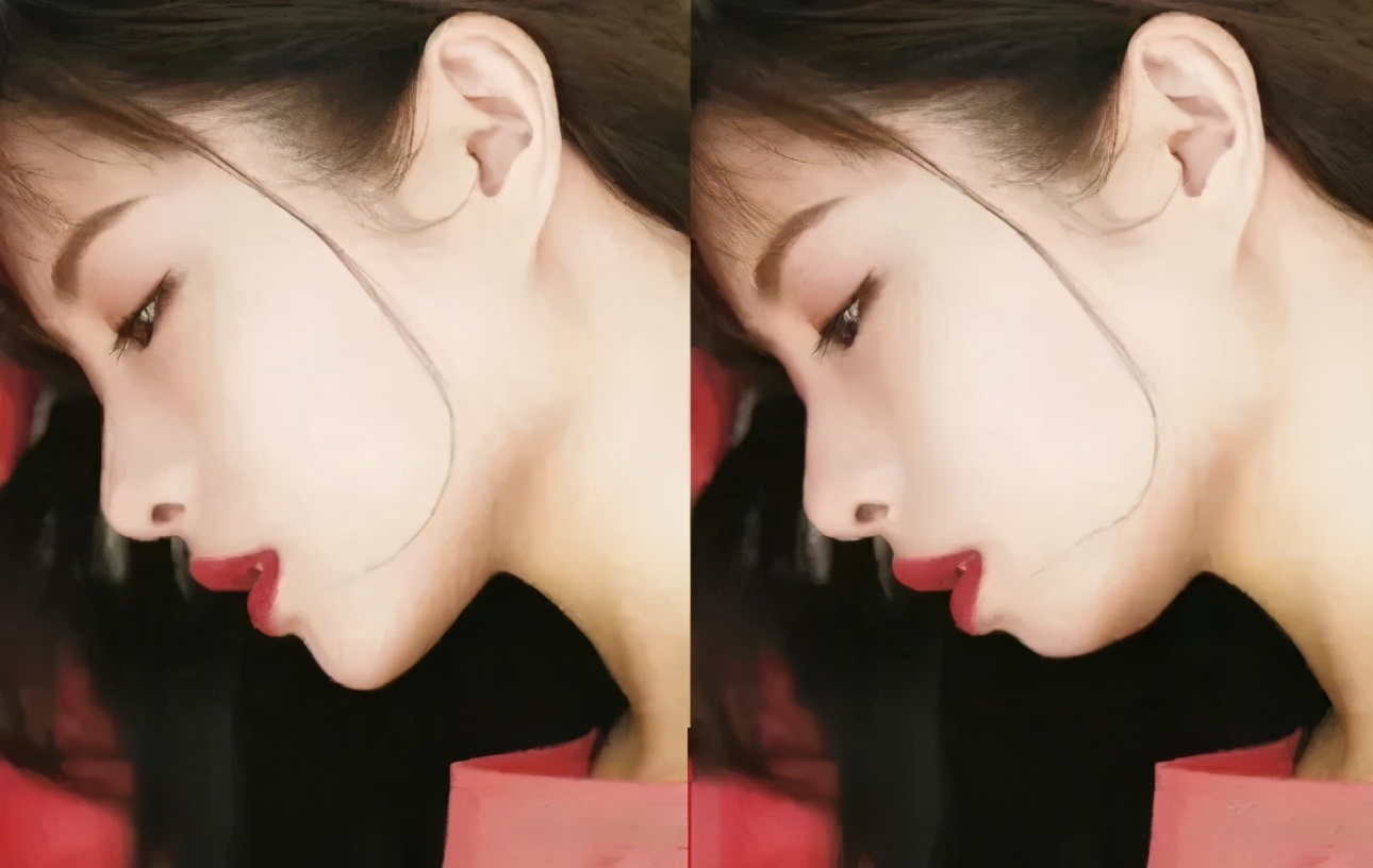 垫下巴能改善脸方吗,下巴短平可以垫下巴吗