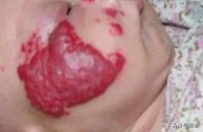 草莓斑胎记,草莓血管瘤胎记