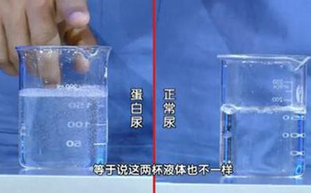 尿里蛋白质是指蛋白尿吗,蛋白尿的含义