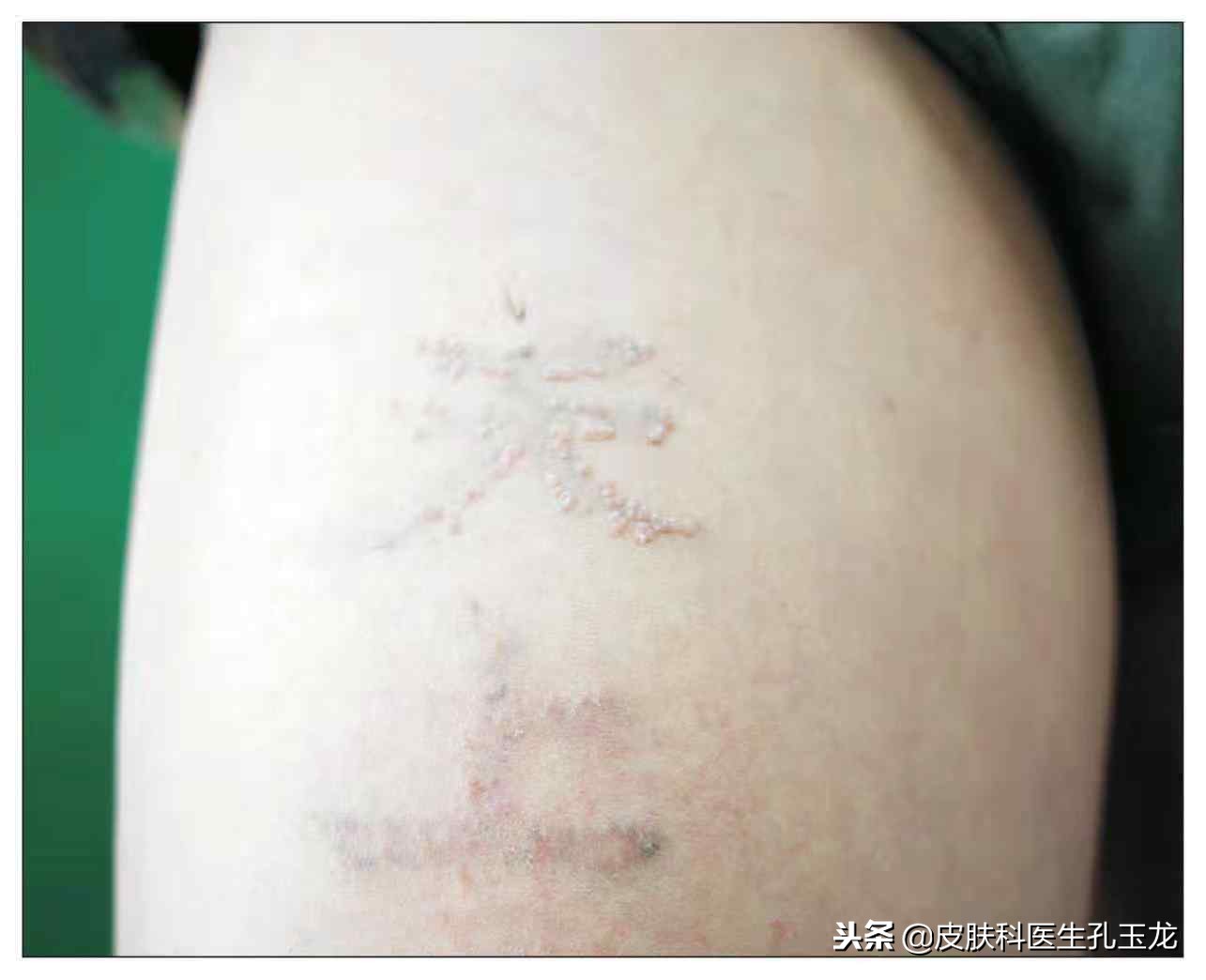 皮肤科疣状症怎么治,皮肤科医院如何治扁平疣