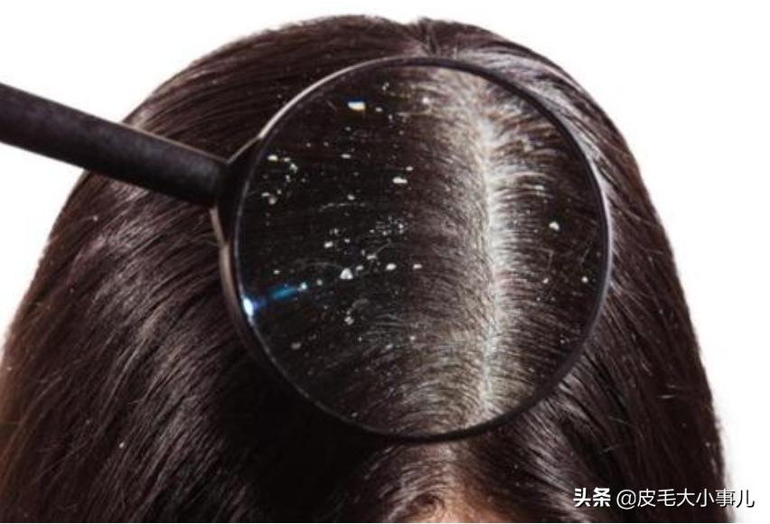 去屑洗发水强力去屑止痒第一名,去屑洗发水强力去屑止痒套装