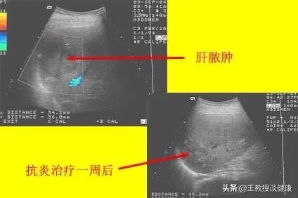 肛周脓肿是不是糖尿病引起的,脓肿为什么会有硬结