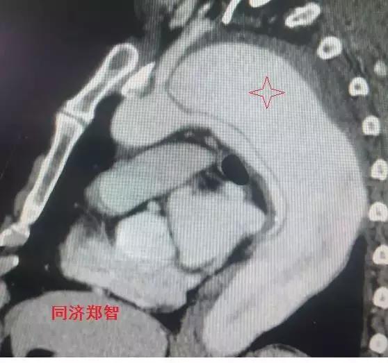磁共振可以替代cta检查主动脉夹层,超声心动图联合cta诊断主动脉夹层