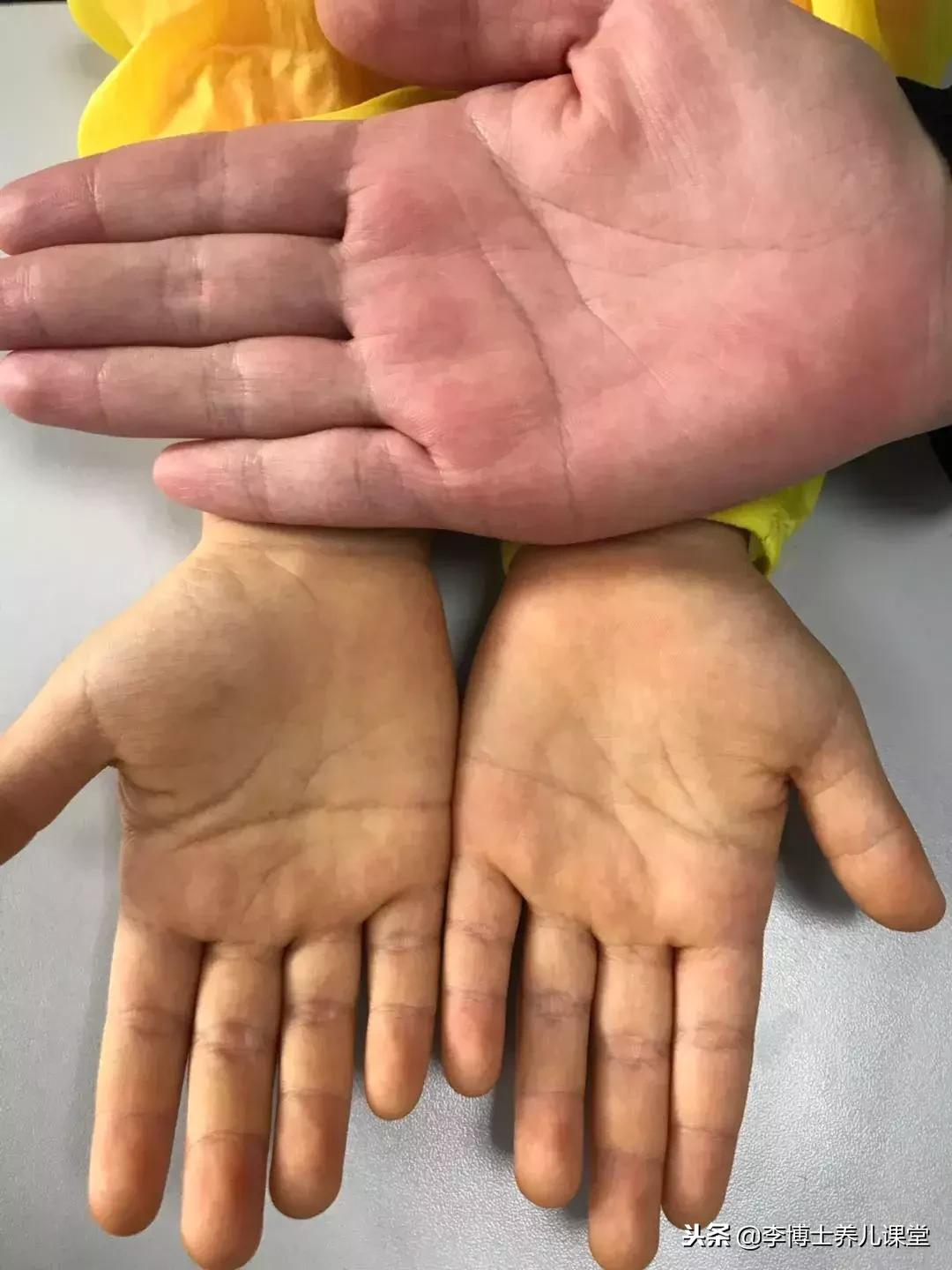 今天接诊了一个手脚皮肤越来越黄的孩子，我却让她回去了！