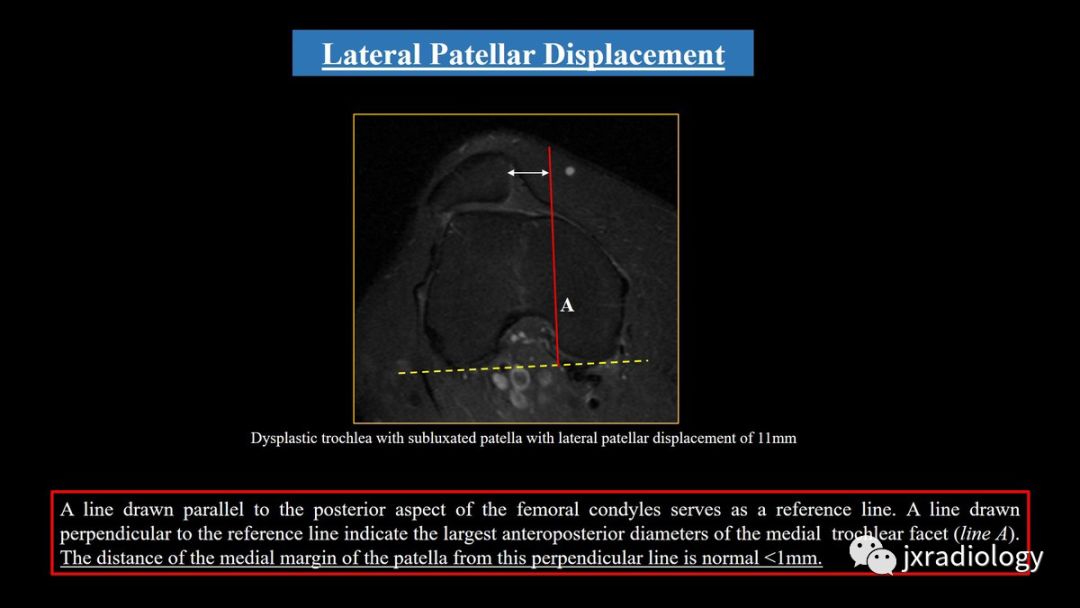 髌股关节失常磁共振看什么,髌股关节混乱的影像评估