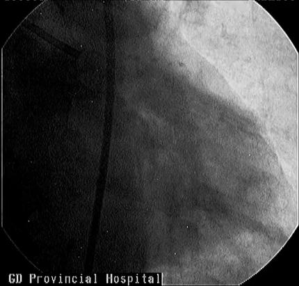 得了腹主动脉瘤该怎么治疗,腹主动脉血管狭窄怎么治疗