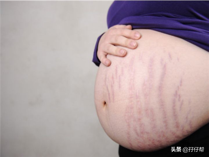 比青春还痛的是，怀上双胞胎的我长妊娠纹了