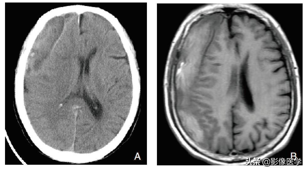 非外伤性硬膜下血肿死亡病例讨论,硬膜下血肿病例