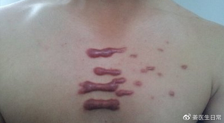 不死的癌症皮肌炎,瘢痕疙瘩为什么被称为不死的癌症