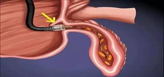 内镜逆行阑尾炎治疗术适应症,急性阑尾炎中西医结合内镜下治疗