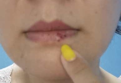 治疗一例咽痛如刀割状、牙痛、唇部疱疹者，一副药未尽剂而愈。