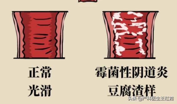 白带增多、脓性灰黄色伴豆渣样、霉菌性阴道炎真的是“发霉”了吗