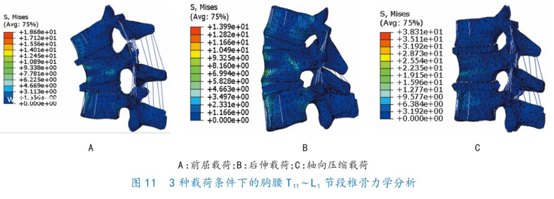 腰1椎体压缩骨折复发要卧床几天,胸12腰4椎体压缩骨折几级工伤