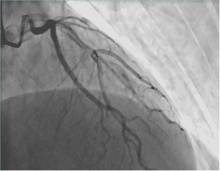 做心脏造影会不会伤害心脏,做心脏造影会不会伤到血管