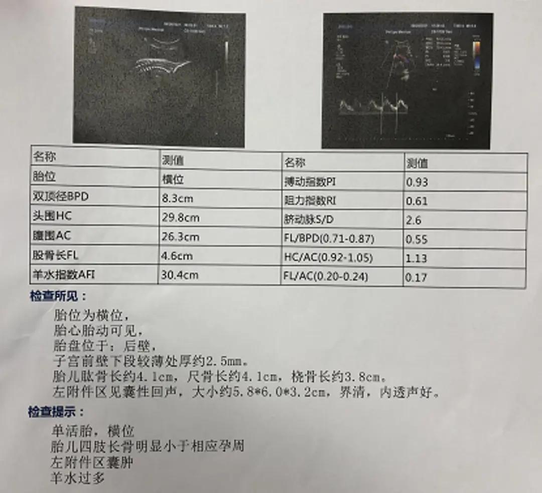产妇b超显示头部偏大,孕期单纯股骨偏小
