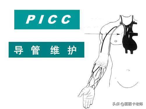 picc置管后管子往里进了怎么办,picc置管维护必须每周做一次吗