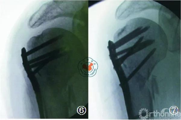 肱骨近端骨折内固定手术的经验与教训