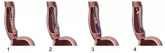 2019三院新技术|消化科：内镜下“钻”隧道切除2.5×7cm食管巨大肿物